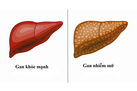 Trị bệnh gan nhiễm mỡ như thế nào?