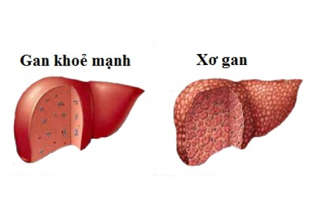 Bệnh xơ gan do rượu